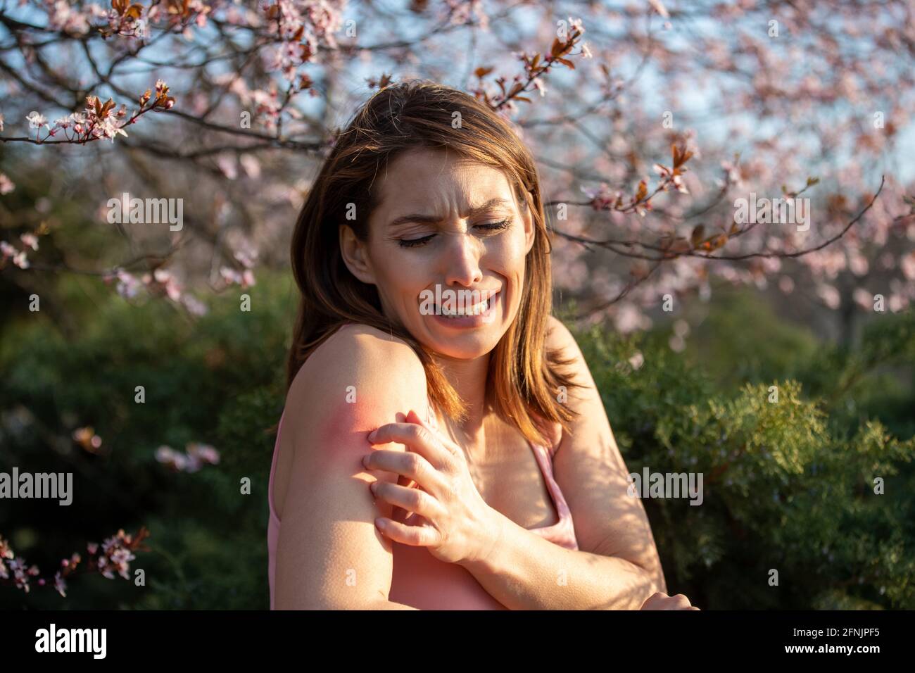 Hübsche junge Frau, die im Frühling neben einem blühenden Baum im Park den Arm kratzt. Rötung und juckende Haut als allergische Reaktion Stockfoto