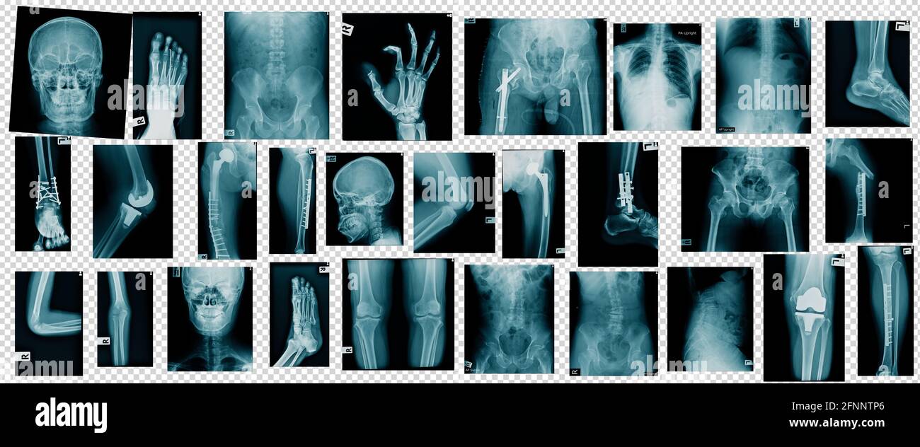 Hochqualitatives Röntgenbild in Blautönen Stockfoto