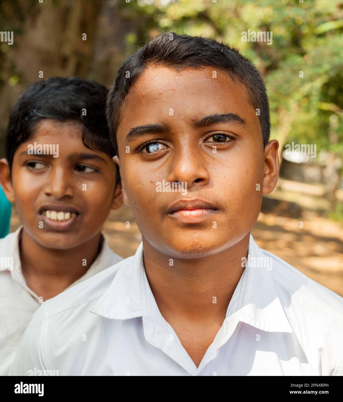 Nahaufnahme des muslimischen srilankischen Schuljungen mit Augenkatarakt, Anuradhapura, Sri Lanka Stockfoto