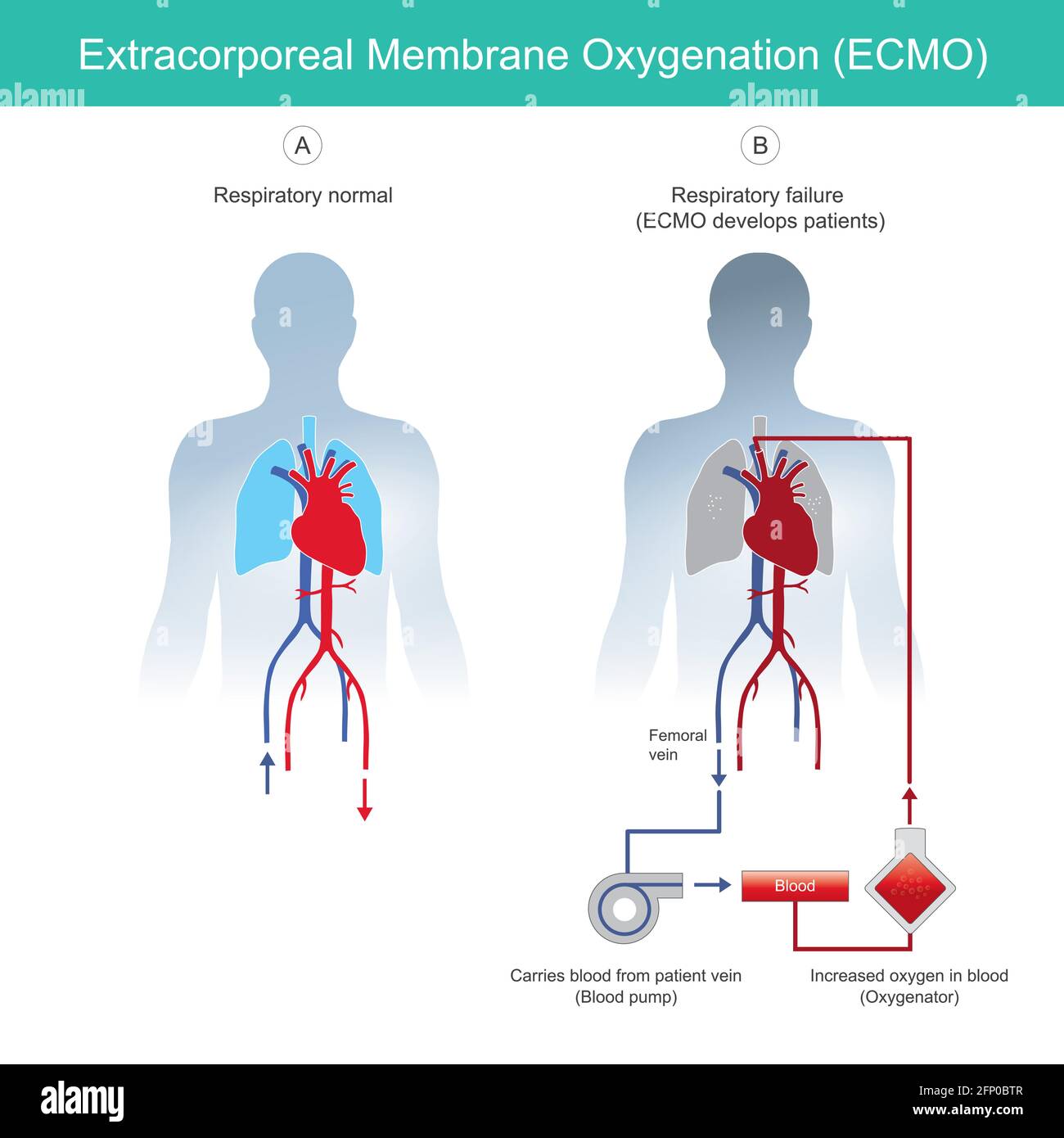 Extrakorporale Membranoxygenierung. Diagramm zur Erklärung der respiratorischen Insuffizienz von Rettungspatienten mit Hilfe der instrumentellen extrakorporalen Membranoxygenatio Stock Vektor
