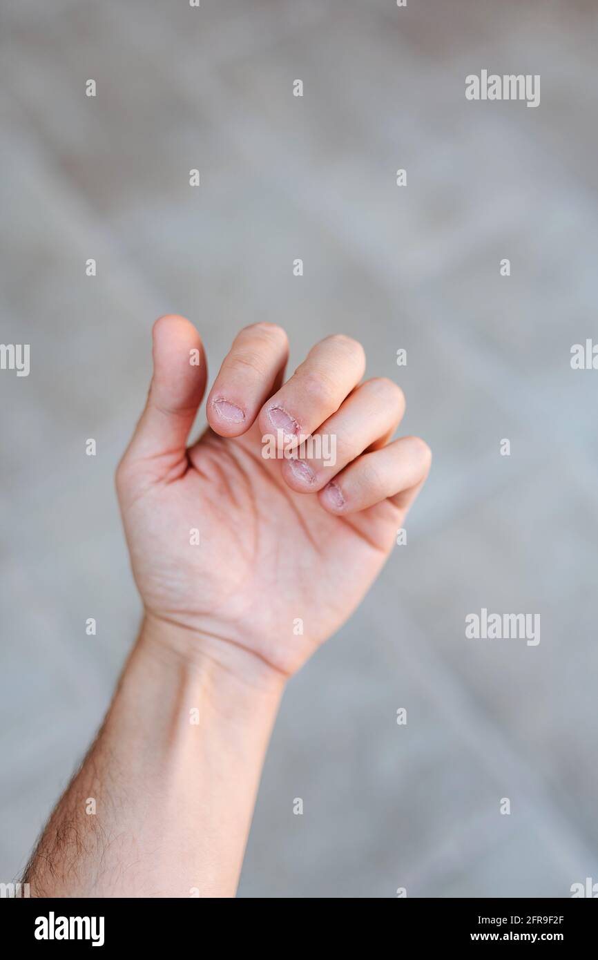 Die Hand eines Mannes mit gebissenen und hässlichen Fingernägeln. Schlechte Pflege der Hände Stockfoto