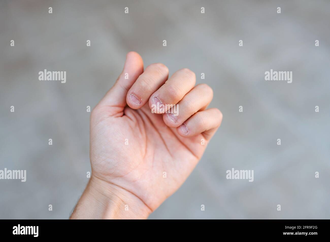Die Hand eines Mannes mit gebissenen und hässlichen Fingernägeln. Schlechte Pflege der Hände Stockfoto