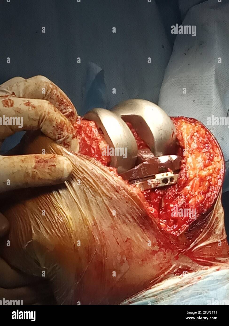 Knochenklemme aus Metall während der Operation am Kniebein Stockfoto