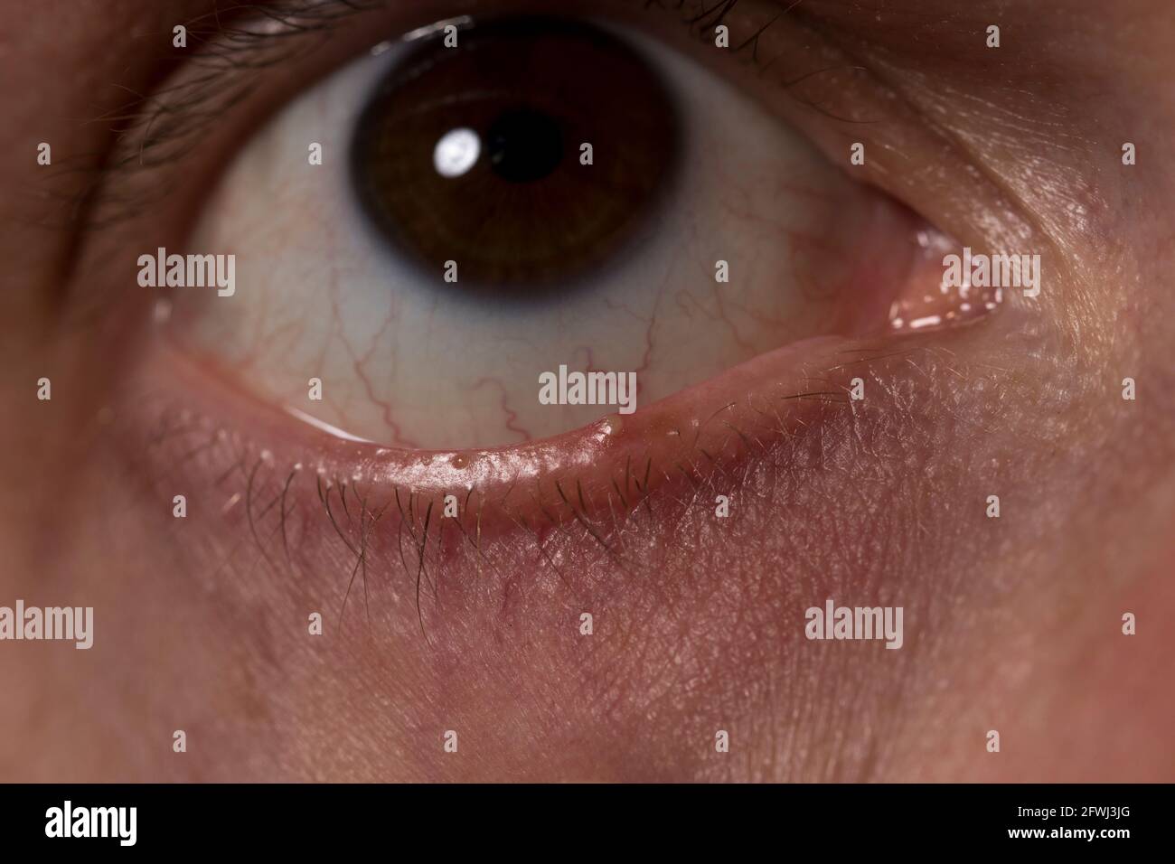 Chalazion Stockfotos und bilder Kaufen Alamy