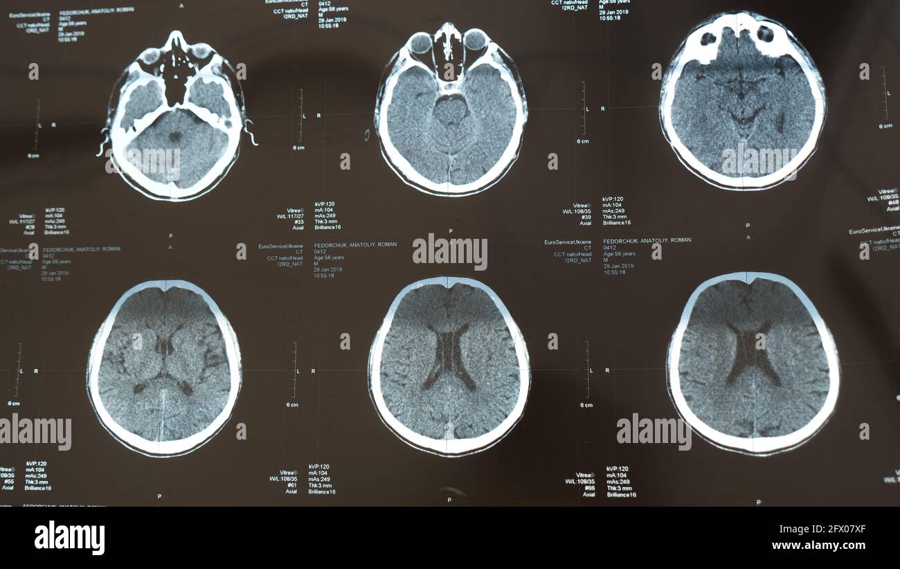 Röntgenaufnahme des Gehirns mit einer Kopfverletzung, Schlaganfallerkrankung im Senior Chegovik. Magnetresonanztomographie, MRT-Nahaufnahme nach Untersuchung im Krankenhaus durch einen Arzt Stockfoto