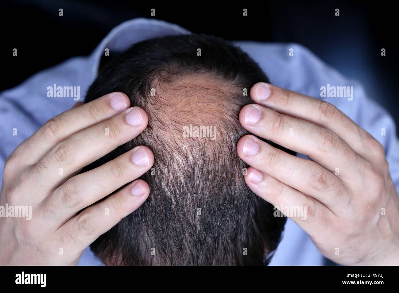 Haarausfall, Mann im Bürohemd besorgt über Haarausfall. Männlicher Kopf mit einer Glatze Stockfoto