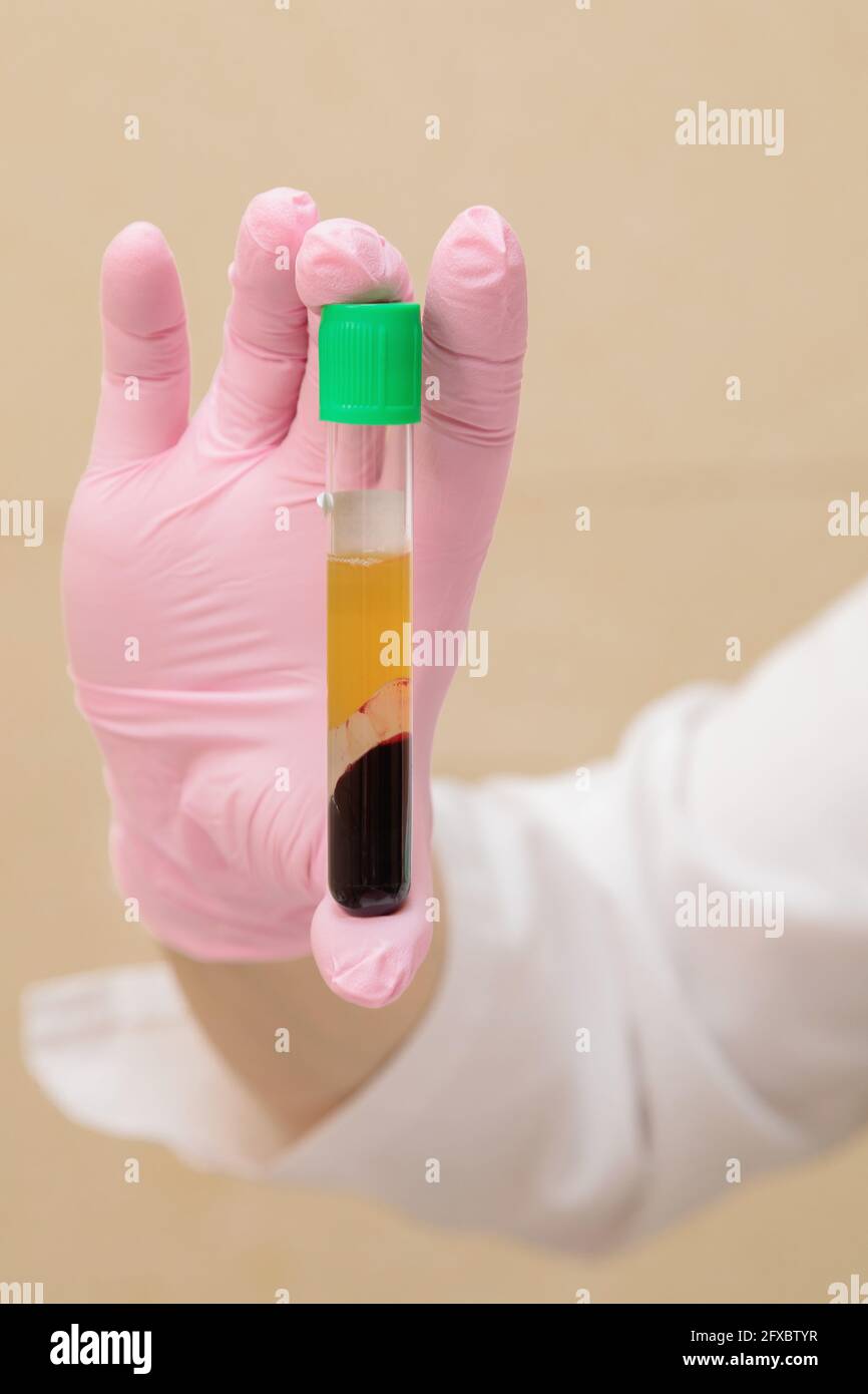 Ein Reagenzglas mit Blutplasma in der Hand eines Spezialisten. Plasmolifting, medizinische Kosmetologie. Stockfoto