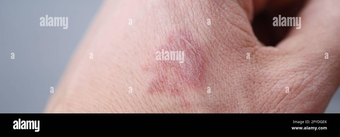 Nahaufnahme von Brandfleck auf mans Hand Stockfoto