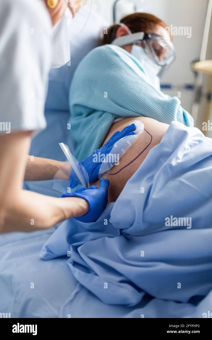 Anwendung eines QUTENZA-Hautpatches auf Basis von Capsaicin (einem Extrakt aus rotem Pfeffer), das zur Behandlung lokalisierter neuropathischer Schmerzen verwendet wird, Stockfoto