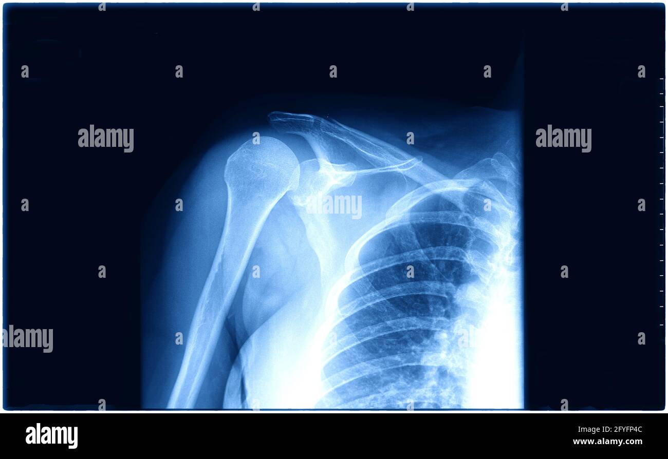 Röntgenbild der menschlichen Brust für eine medizinische Diagnose, ein Coronavirus oder ein Covid-19-Konzept Stockfoto