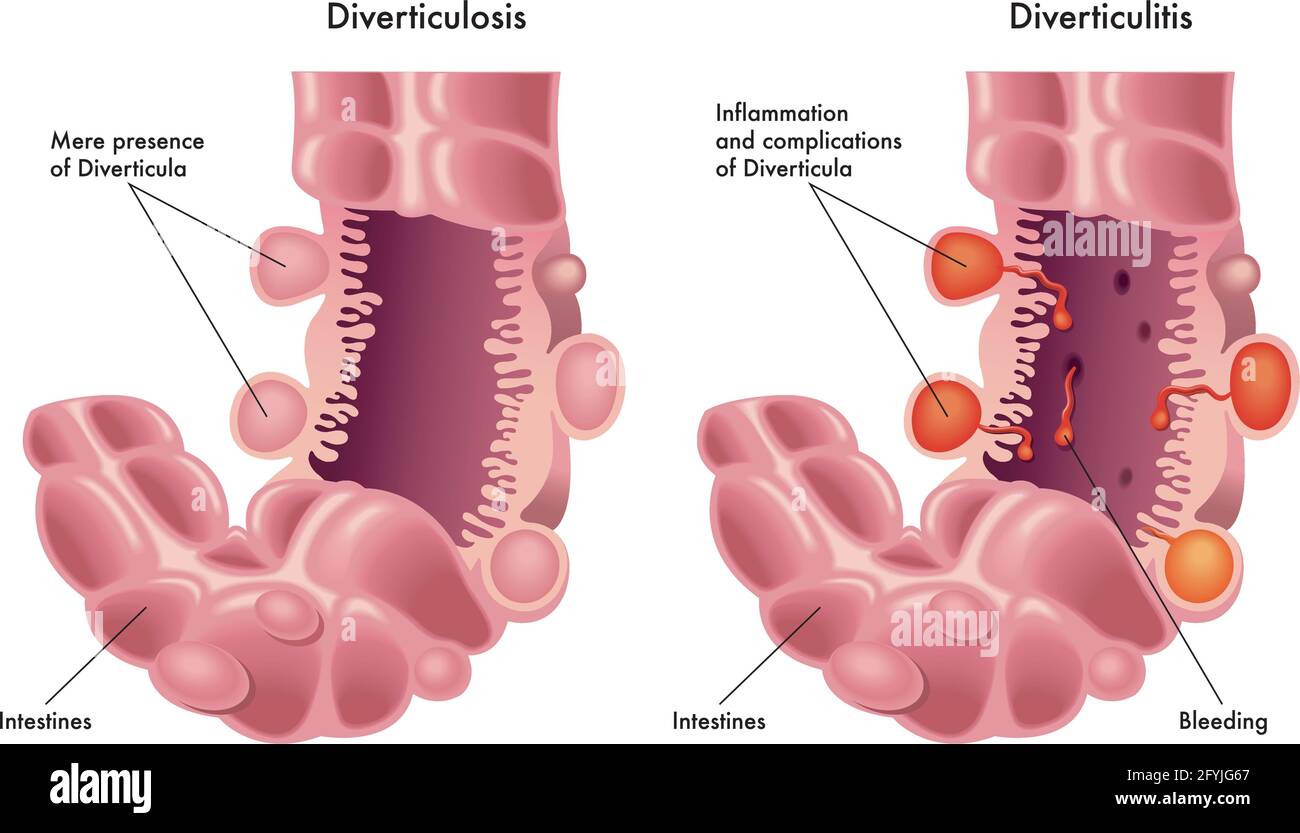 Medizinische Illustration des Unterschieds zwischen Divertikulose und Divertikulitis. Stock Vektor
