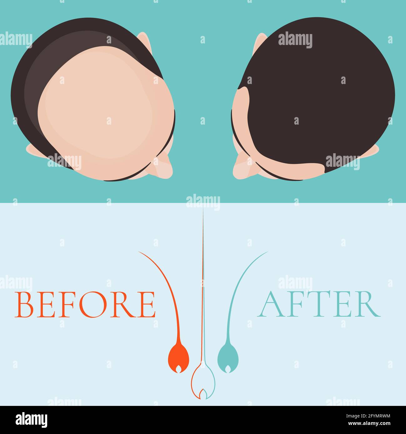 Haarausfall Behandlung für Männer, konzeptionelle Illustration Stockfoto
