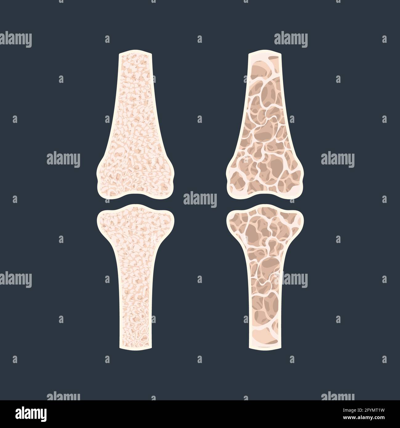 Osteoporose, konzeptuelle Illustration Stockfoto