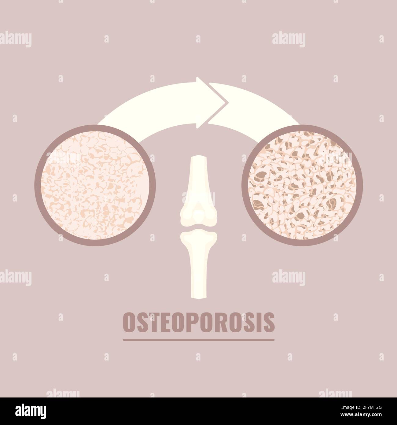 Osteoporose, konzeptuelle Illustration Stockfoto