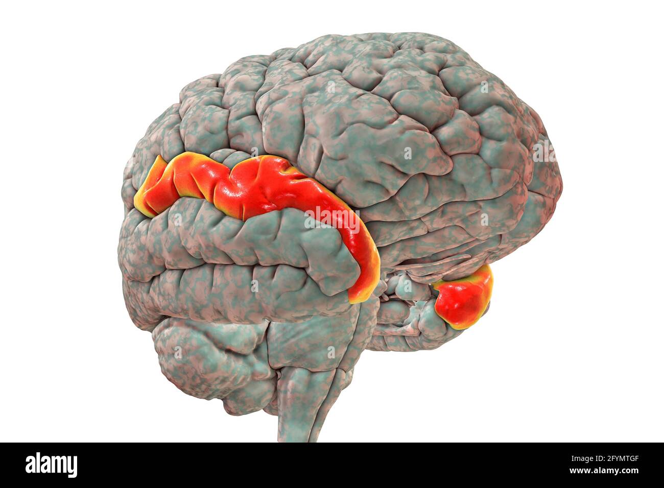 Gehirn, das den oberen Temporalgyrus hervorhebt, Illustration Stockfoto
