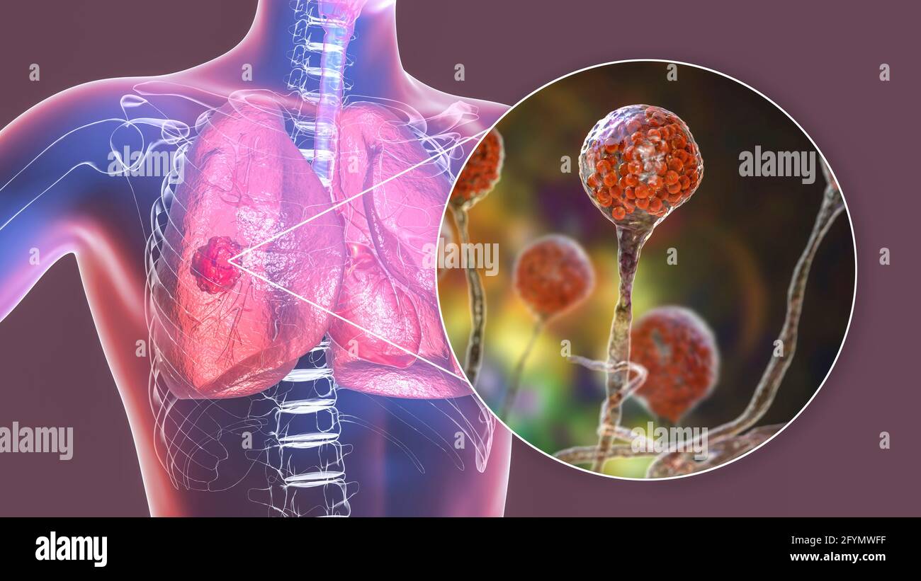 Pulmonale Mukormykose, Illustration Stockfoto