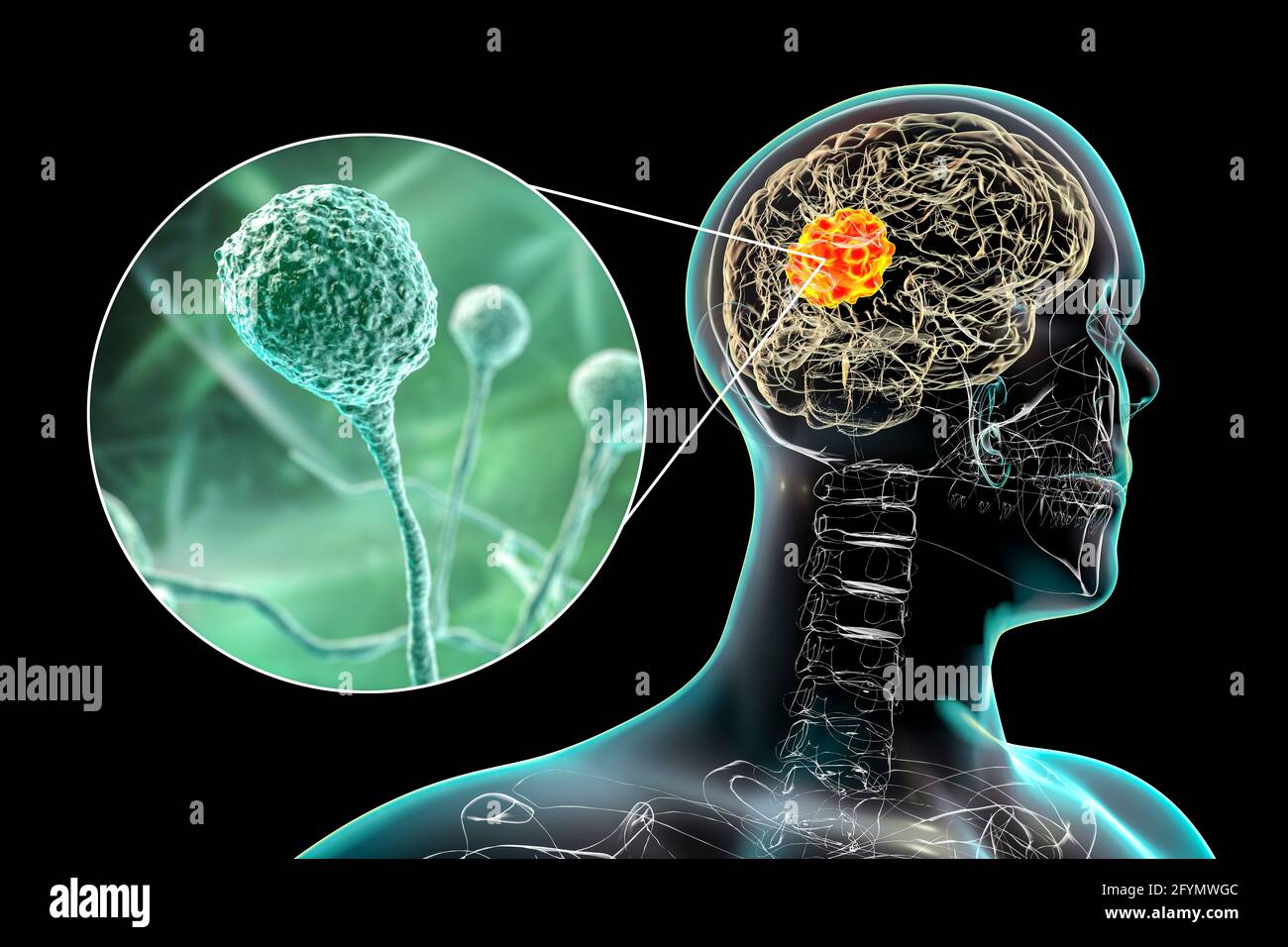 Hirnmukormykose, Illustration Stockfoto