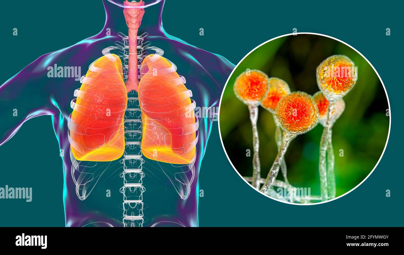 Pulmonale Mukormykose, Illustration Stockfoto