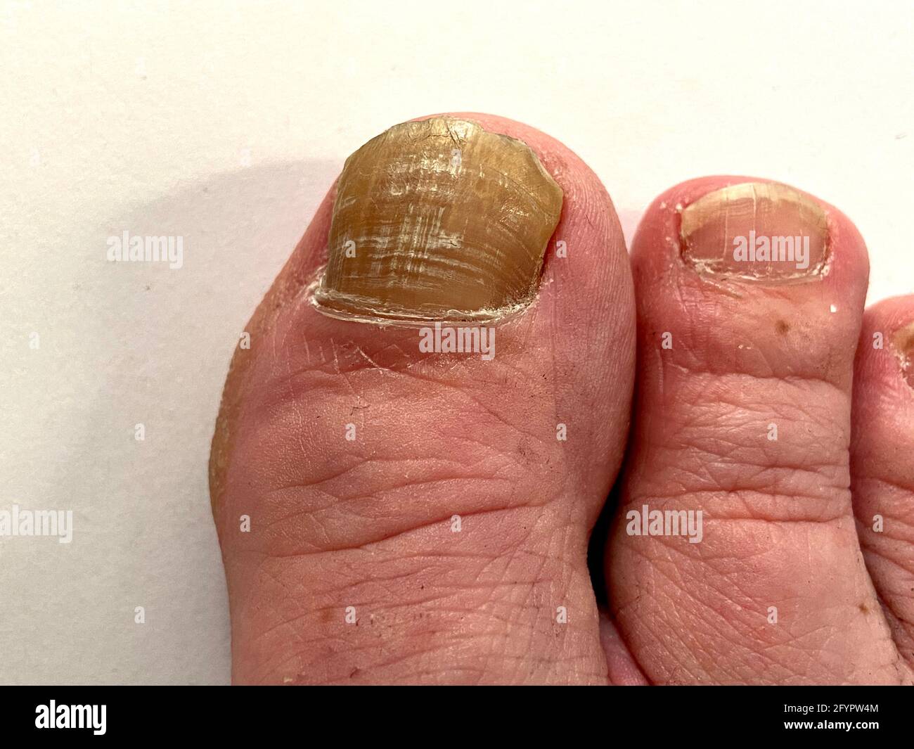 Wunderschone Gelbe Zehennagel Leber Bilder