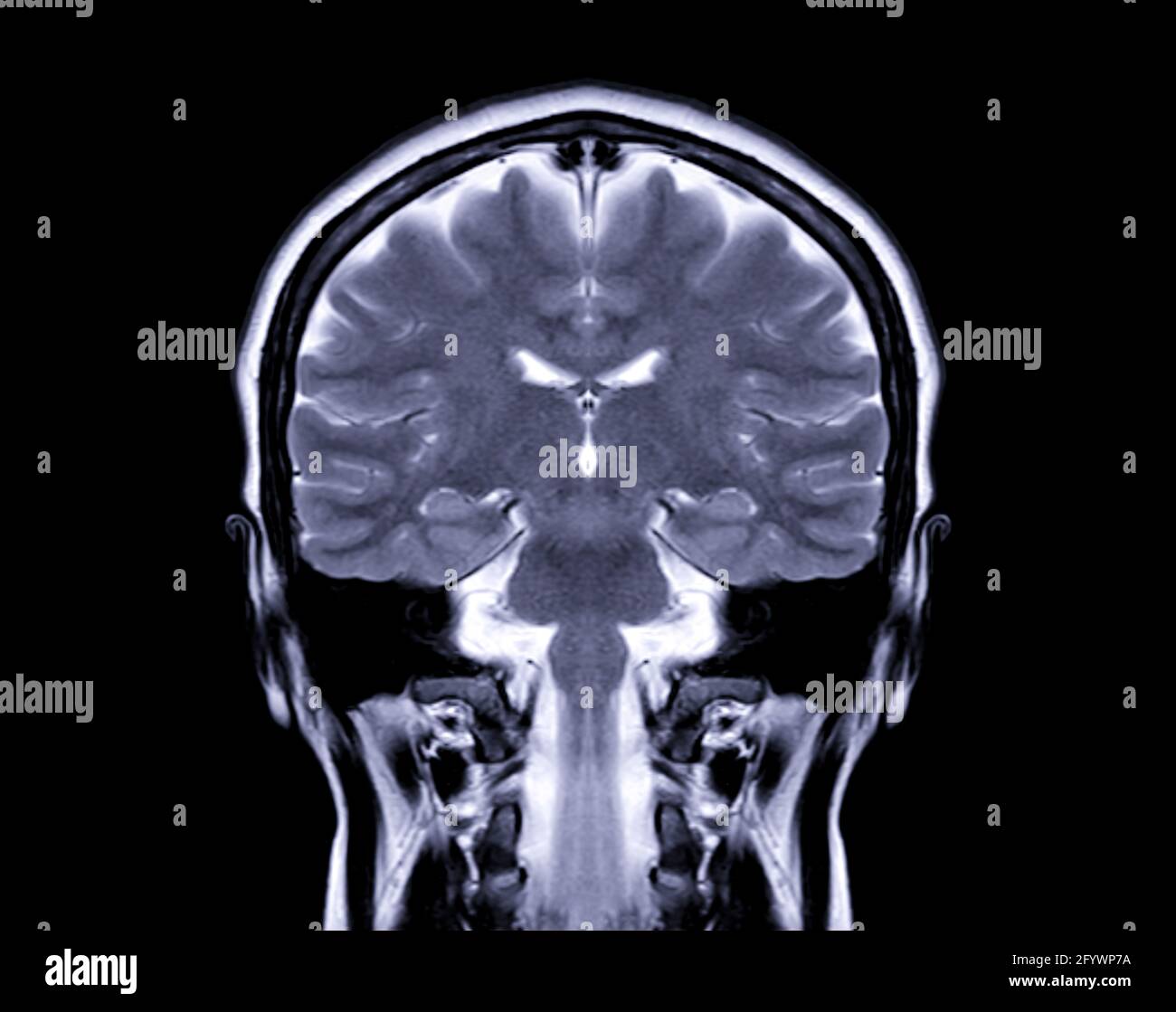 MRI Brain Coronal T2W-Ansicht zur Detektion einer Vielzahl von Erkrankungen des Gehirns wie Zysten, Tumoren, Blutungen isoliert auf dem Bildschirm. Stockfoto