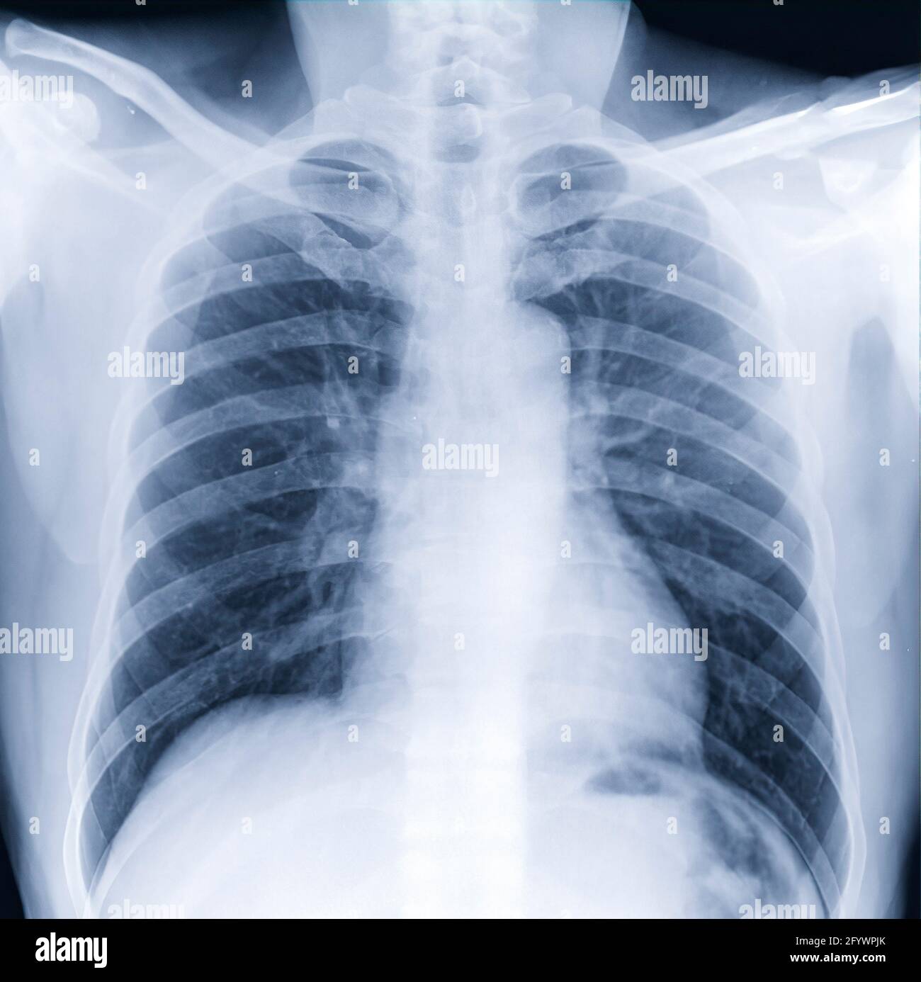 Röntgen-Thorax oder Röntgenbild der menschlichen Brust für eine medizinische Diagnose . Check up Konzept. Stockfoto