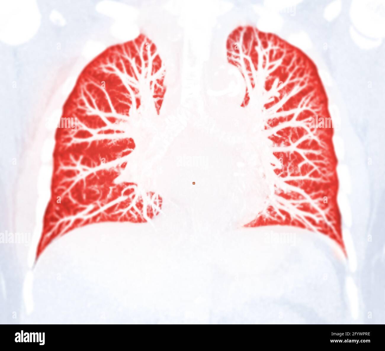 CT Chest Lung Preset für erkannte Tuberkulose-Tuberkulose (TB) und Coronavirus 2019. Stockfoto