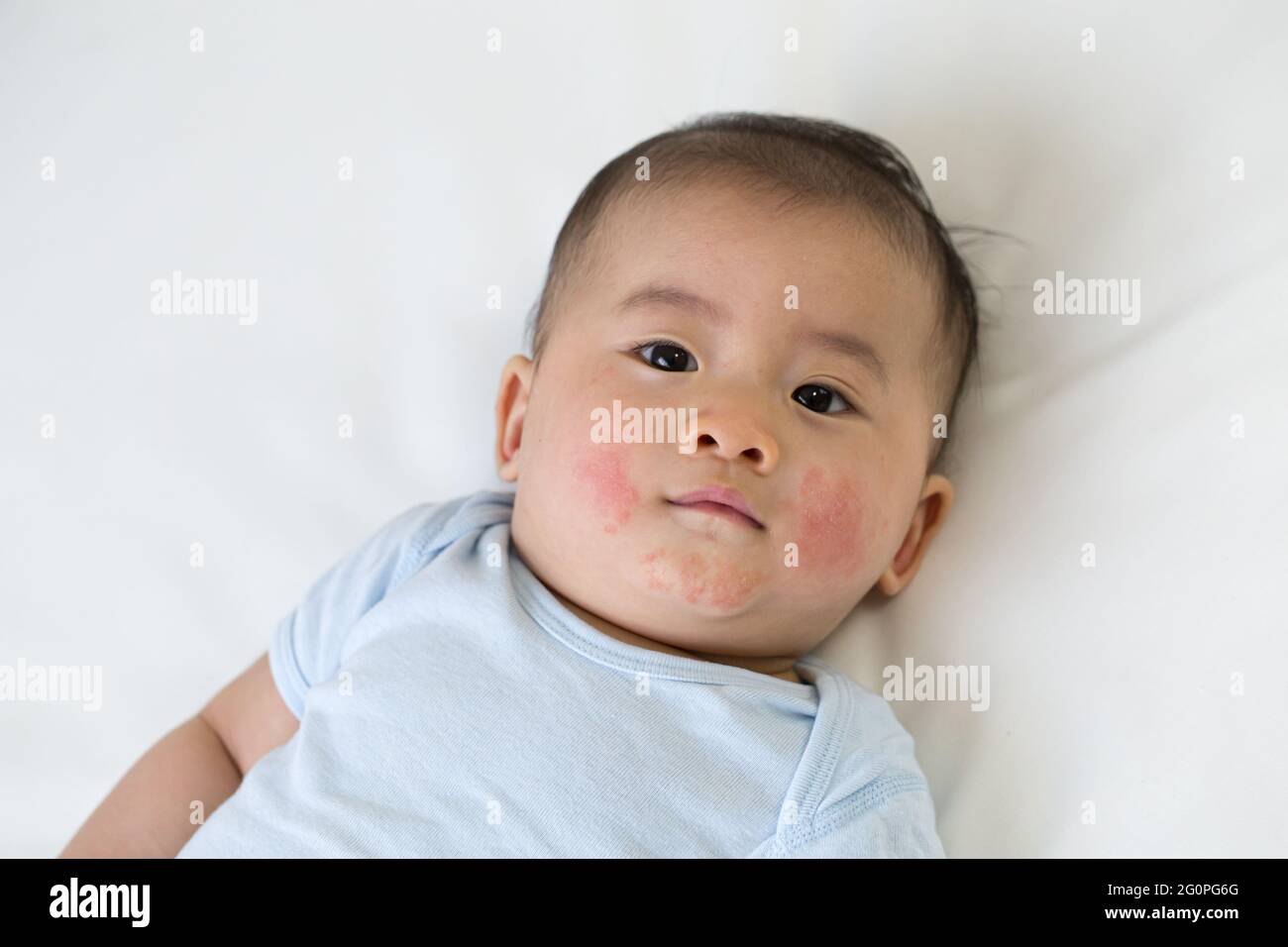 Asiatischer Baby Junge lag auf dem Bett und hatte einen roten Ausschlag auf dem Gesicht, Haut gemeinsame Ausschläge in neugeborenen Konzept Stockfoto