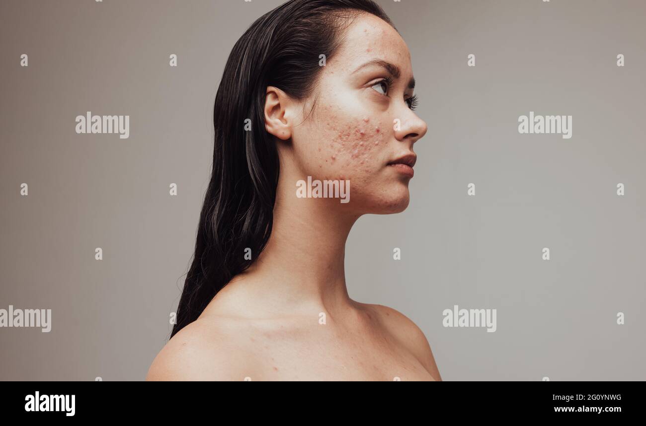 Seitenansicht Porträt einer Frau mit Akne. Nahaufnahme der traurigen Frau mit Hautproblem. Stockfoto
