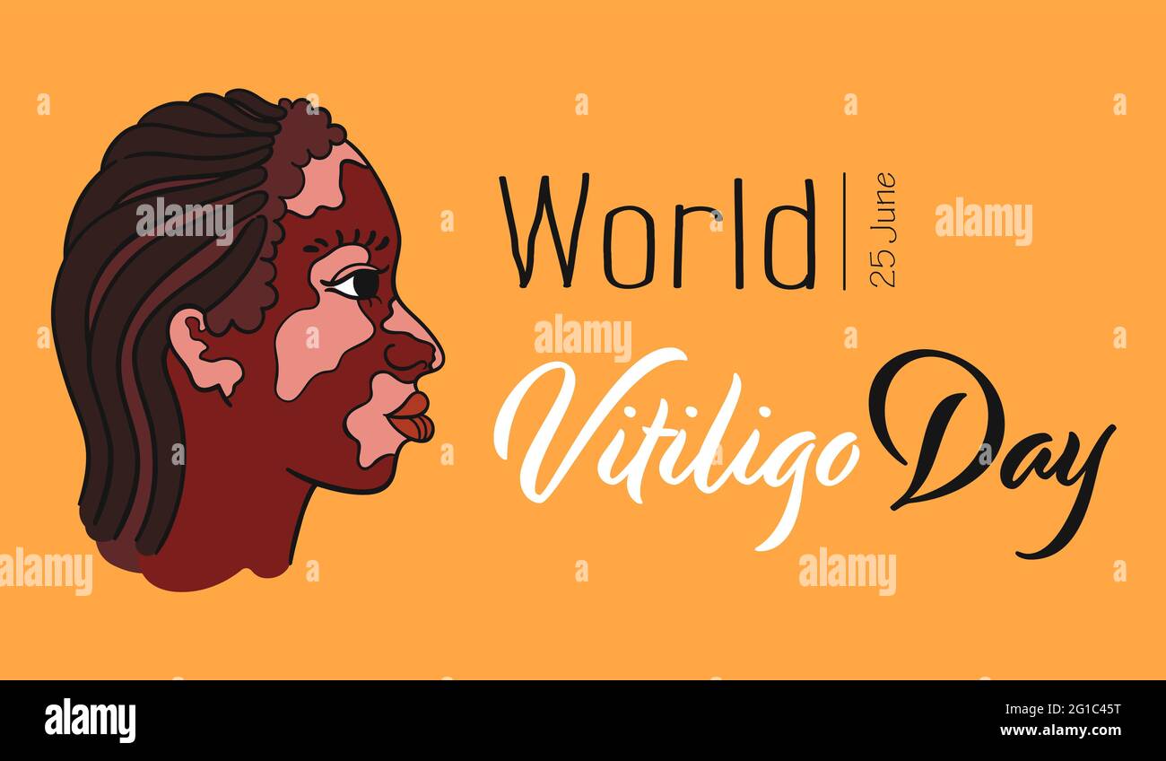 Welt-Vitiligo-Tag. Dreadlocks Haar Mädchen mit Vitiligo Pigmentflecken. Seitenansicht Porträt der Frau - isoliert Vektor Stock Vektor