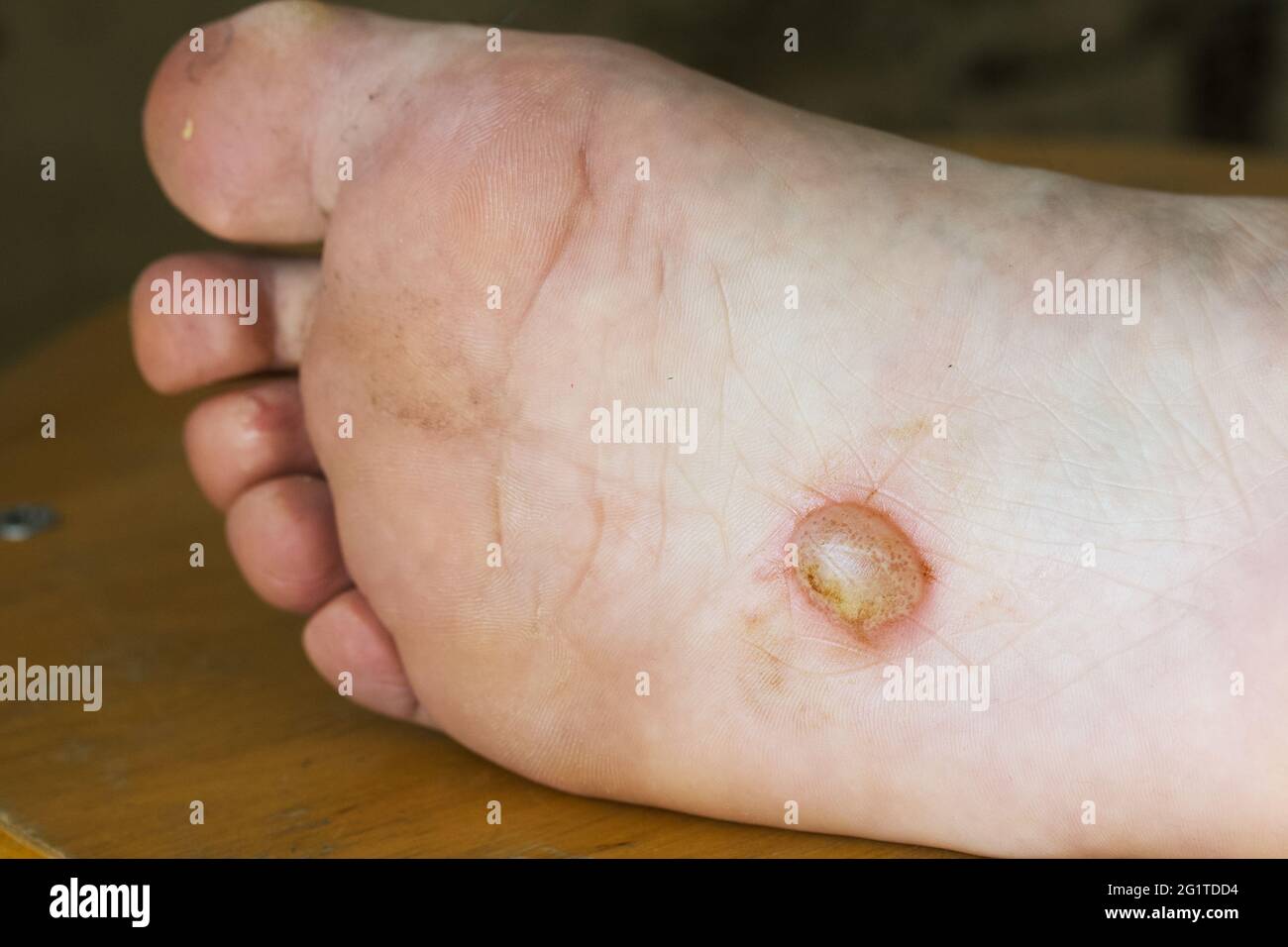 Dermatitis Stockfotos und bilder Kaufen Alamy