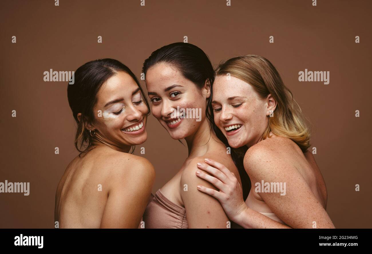 Fröhliche Frauen stehen vor braunem Hintergrund zusammen. Drei junge Frauen mit Hautproblemen scheinen über ihre Unvollkommenheiten hinauszuschauen und glücklich zu sein. Stockfoto