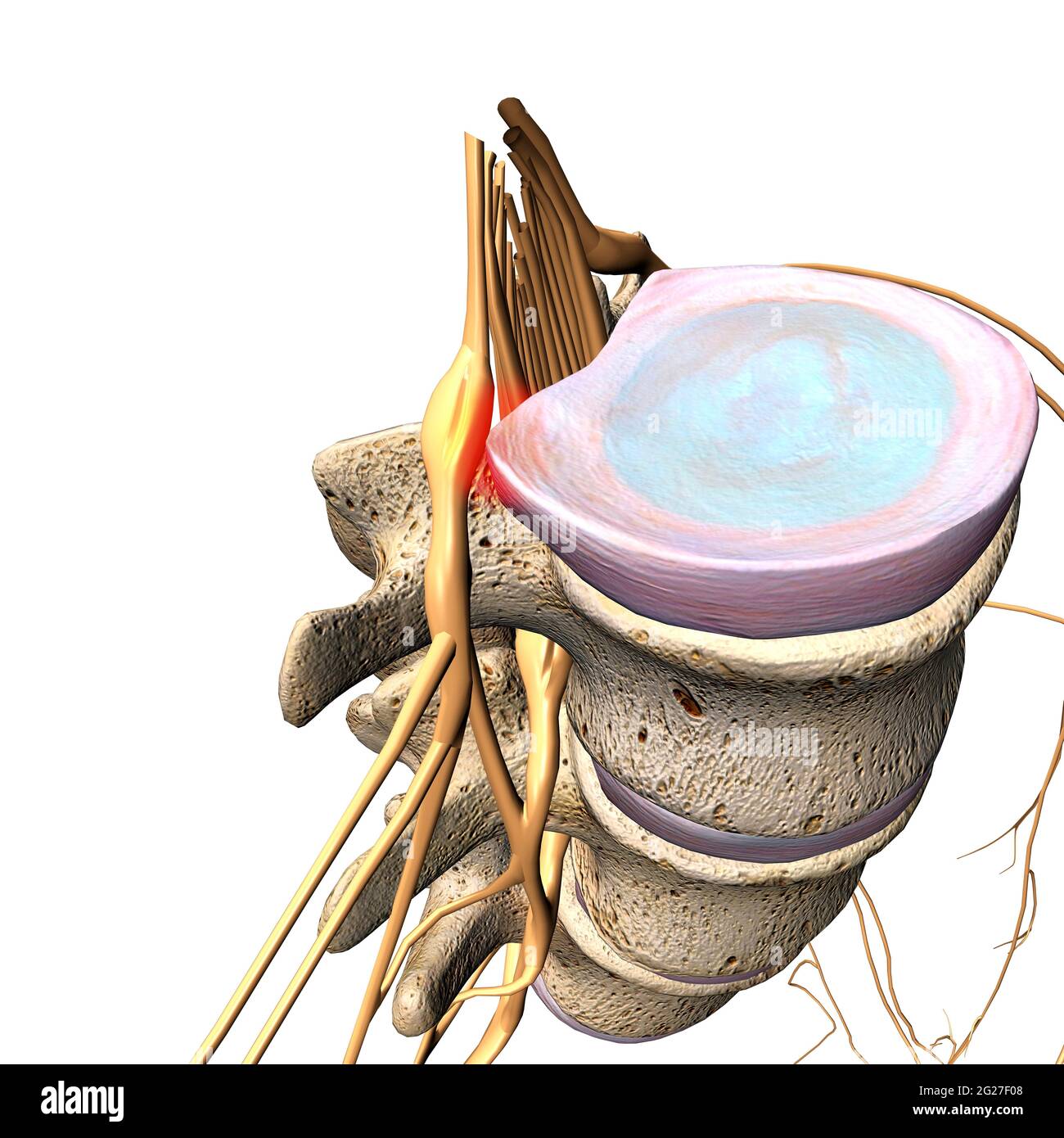 Bandscheibenvorfall, der auf einen Rückenmarksnerv drückt, auf weißem Hintergrund. Stockfoto