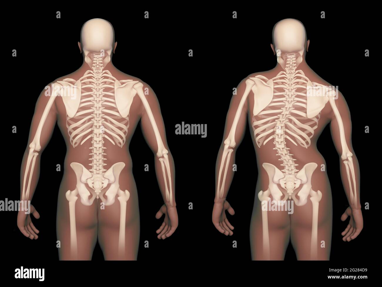Vergleich einer normalen menschlichen Wirbelsäule mit einer Wirbelsäule mit Skoliose. Stockfoto