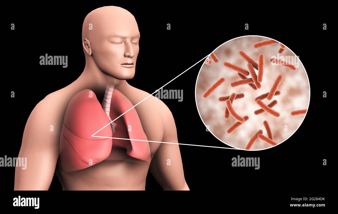 Biomedizinische Darstellung der Tuberkulose in der menschlichen Lunge, mit vergrößerter Sektion. Stockfoto
