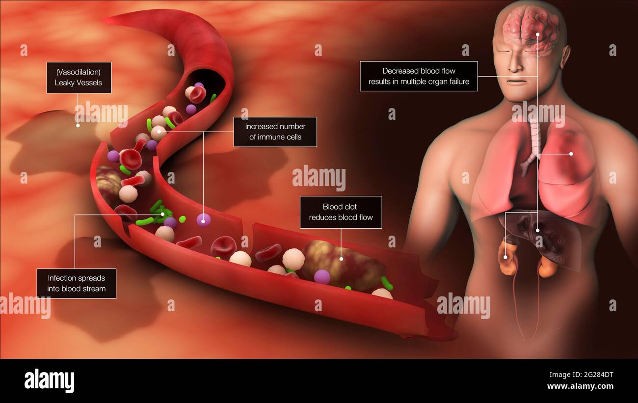 Biomedizinische Darstellung einer Sepsis im Blutkreislauf, die Entzündungsreaktionen im ganzen Körper auslöst. Stockfoto