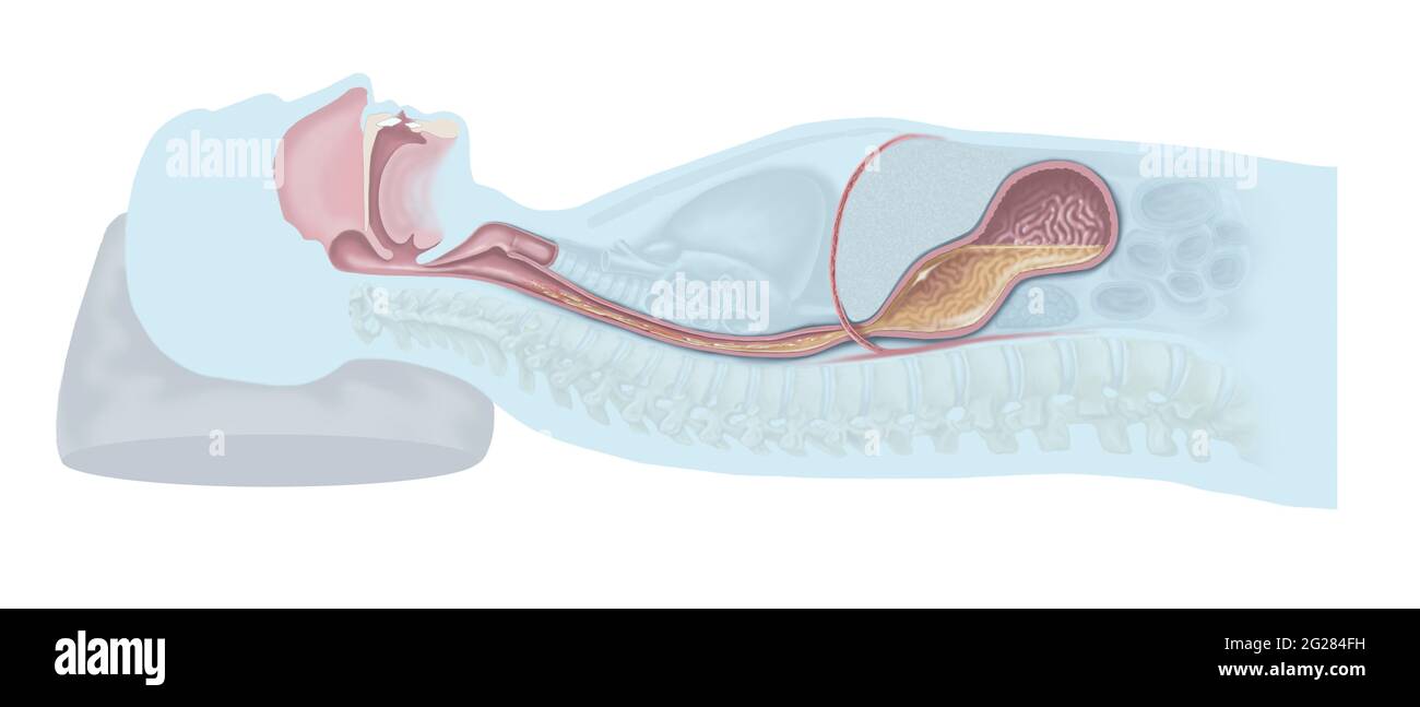 Geneigter Körper mit Regurgitation der Magensäure - GERD. Stockfoto