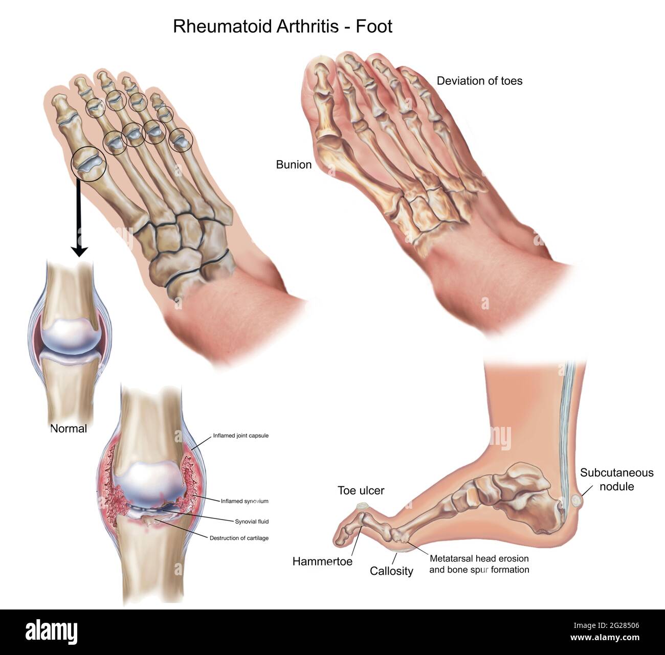 Ober- und Seitenansicht des Fußes mit Fehlbildungen, die durch rheumatoide Arthritis verursacht werden. Stockfoto