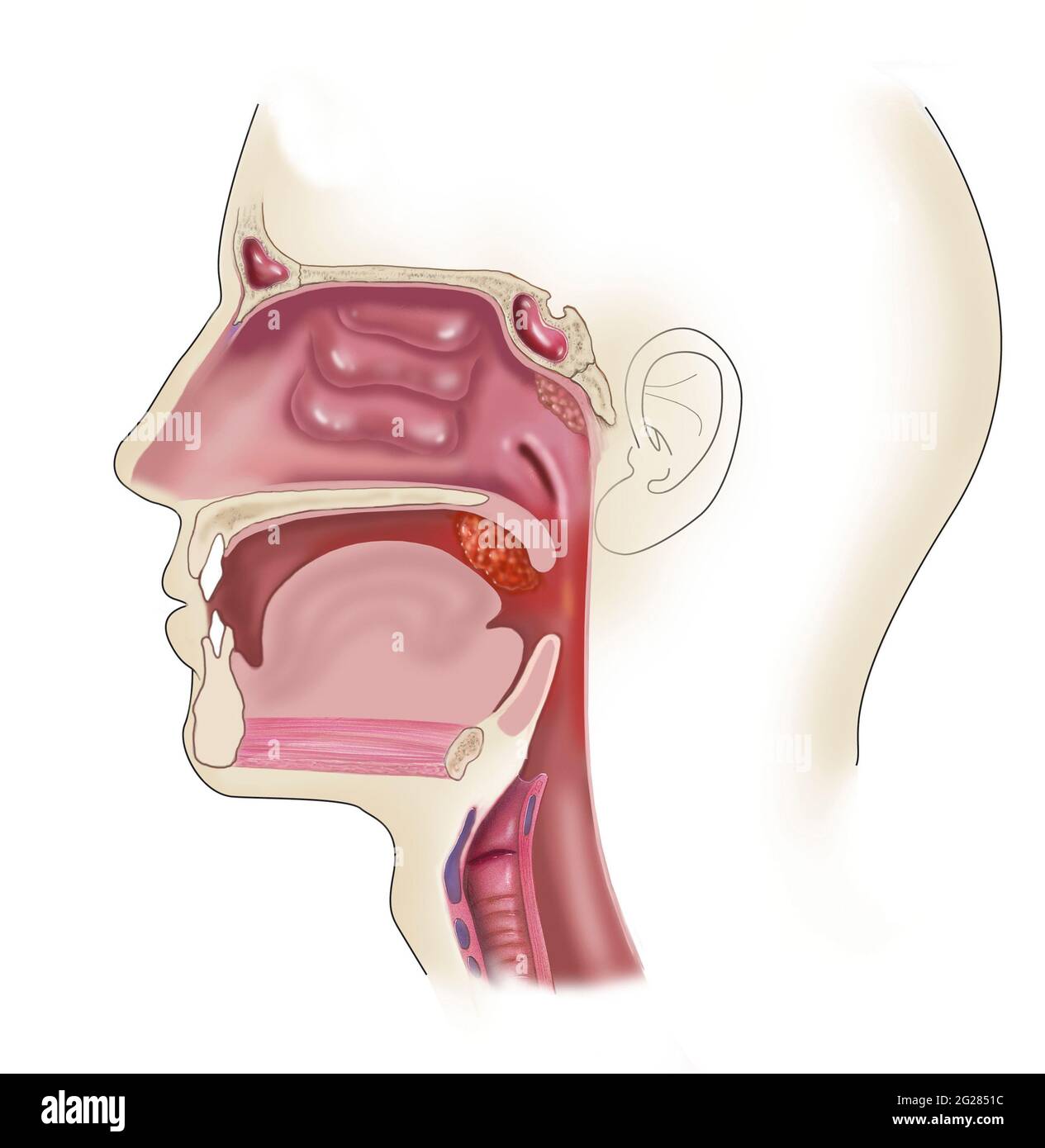 Seitenansicht des Kopfes, wo sich geschwollene und vergrößerte Mandeln befinden. Stockfoto