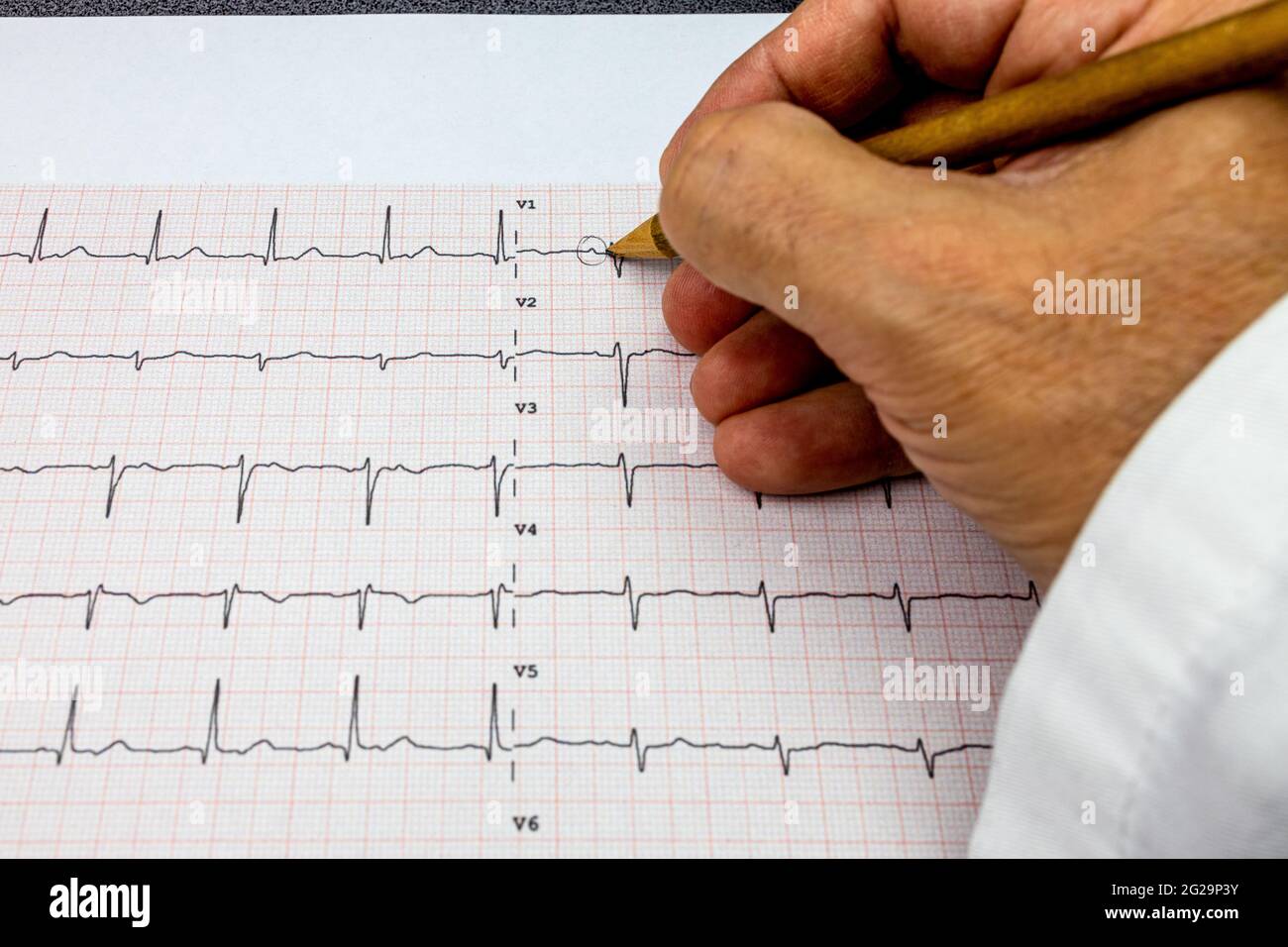 Arzt, der eine EKG-12-Ableitung analysiert und die in der Kurve vorhandenen P-Wellen mit einem Bleistift markiert, Nahaufnahme Stockfoto