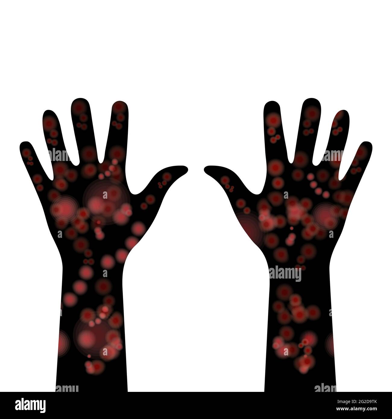Meningitis Ausschlag bei dunkleren Hauttönen. Hände mit rotem Ausschlag bedeckt. Krankheiten bei ethnischen Minderheiten. Flecken auf den Händen. Medizinische Anzeichen und Symptome einer Krankheit Stock Vektor