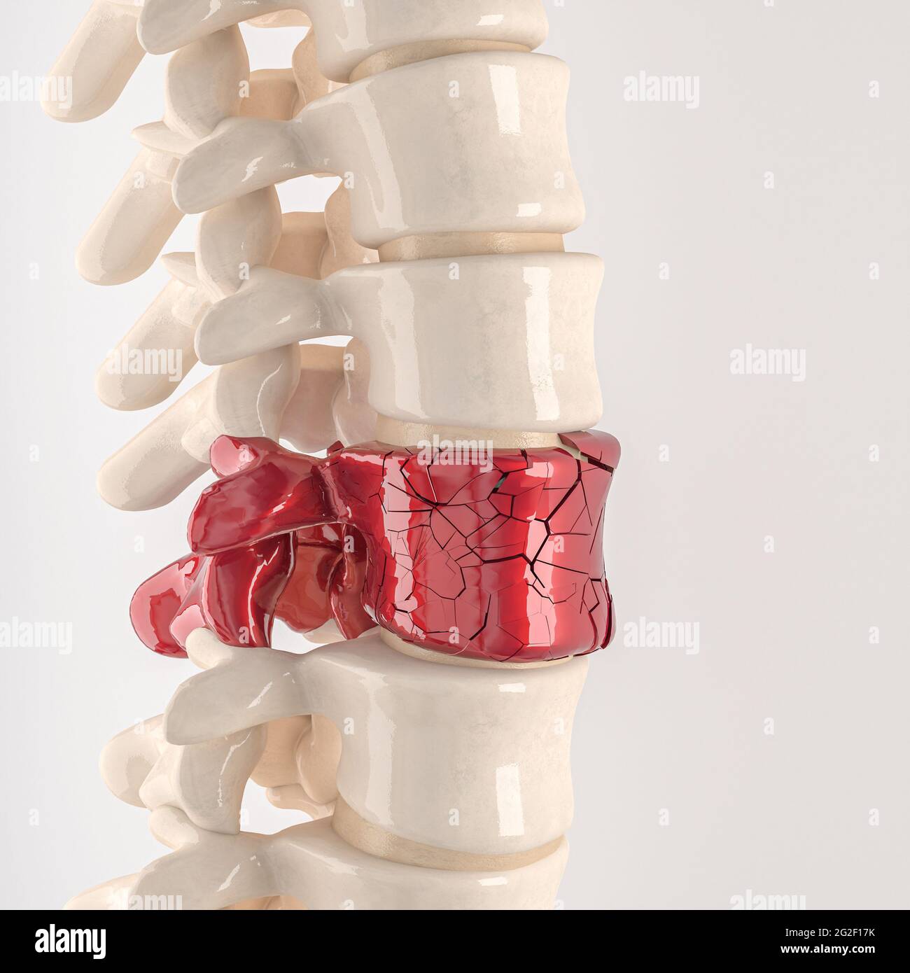 Wirbelsäule mit zerbrochenen Wirbeln. Konzept der körperlichen Beschwerden. 3d-Rendering Stockfoto