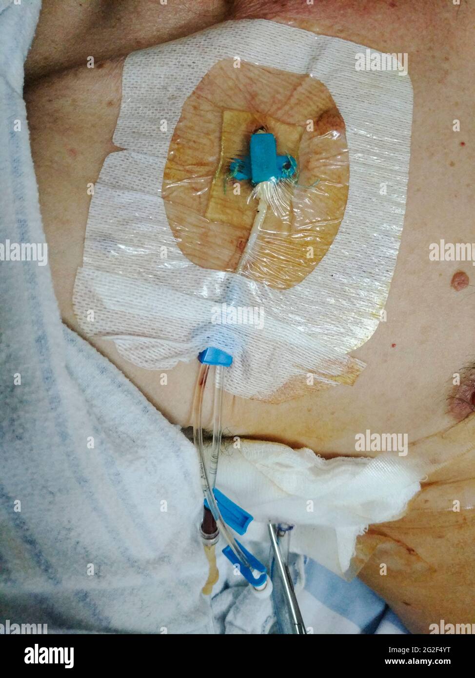Narbe patient brust wunde operation Fotos und Bildmaterial in hoher Auflösung Alamy