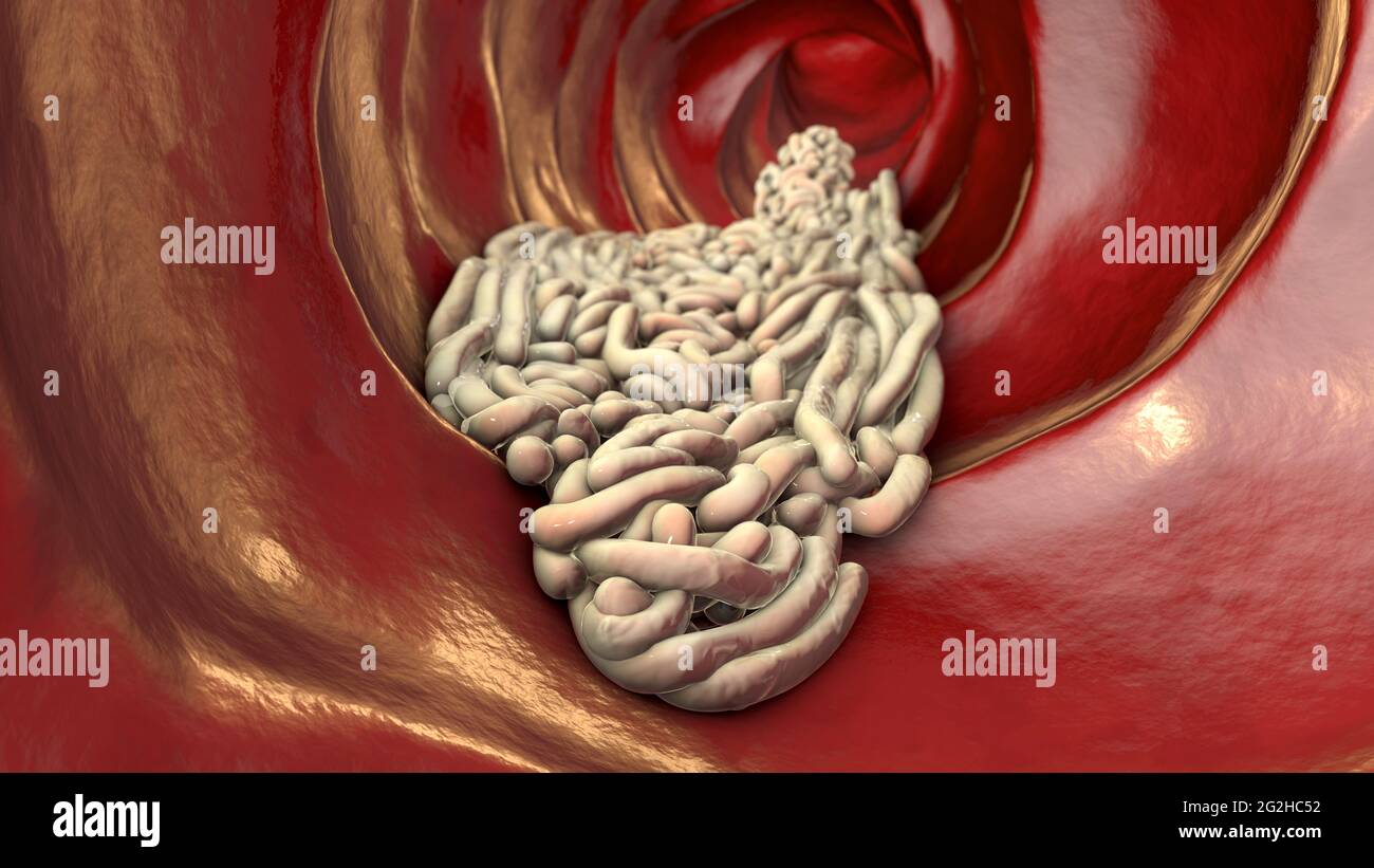 Runde Würmer im menschlichen Darm, Illustration Stockfoto