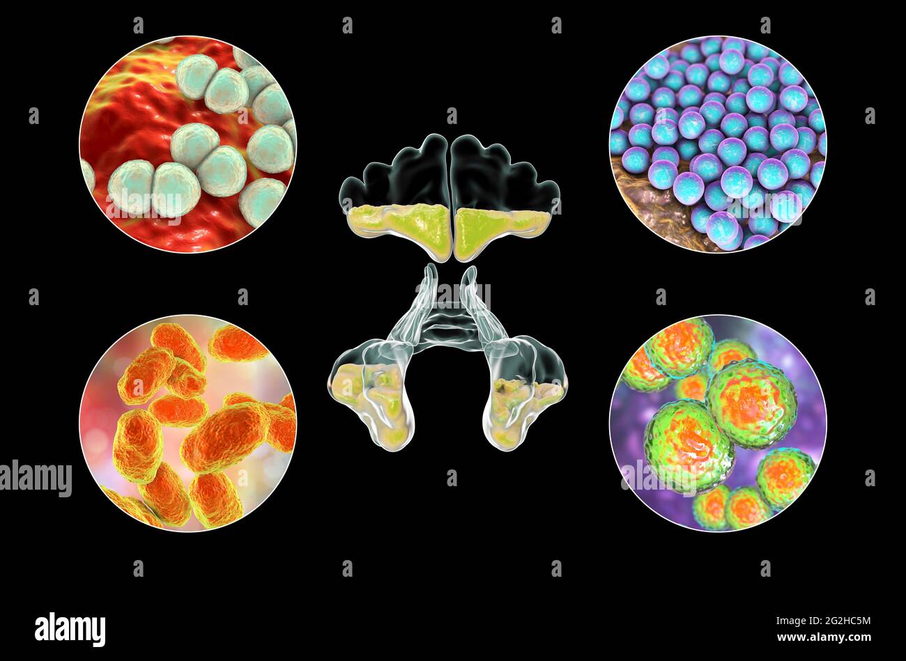 Sinusitis, Abbildung Stockfoto