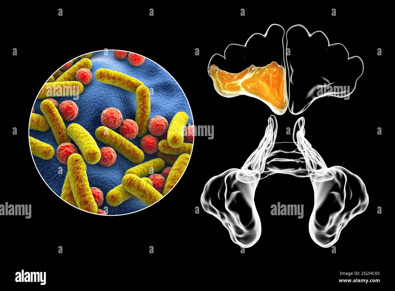 Sinusitis, Abbildung Stockfoto