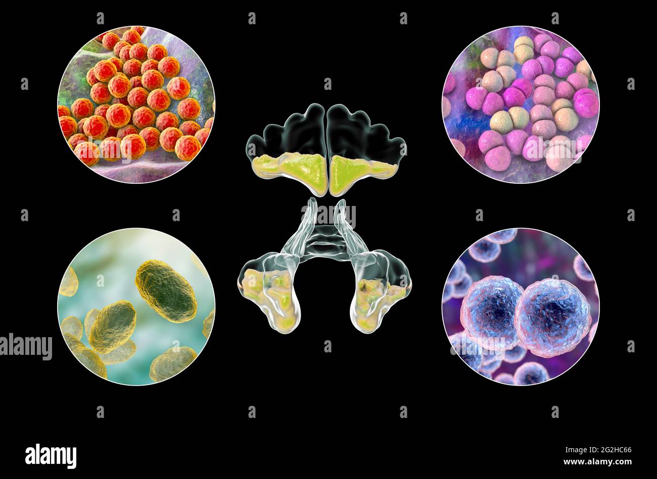 Sinusitis, Abbildung Stockfoto