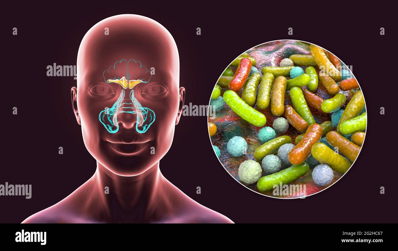 Sinusitis, Abbildung Stockfoto