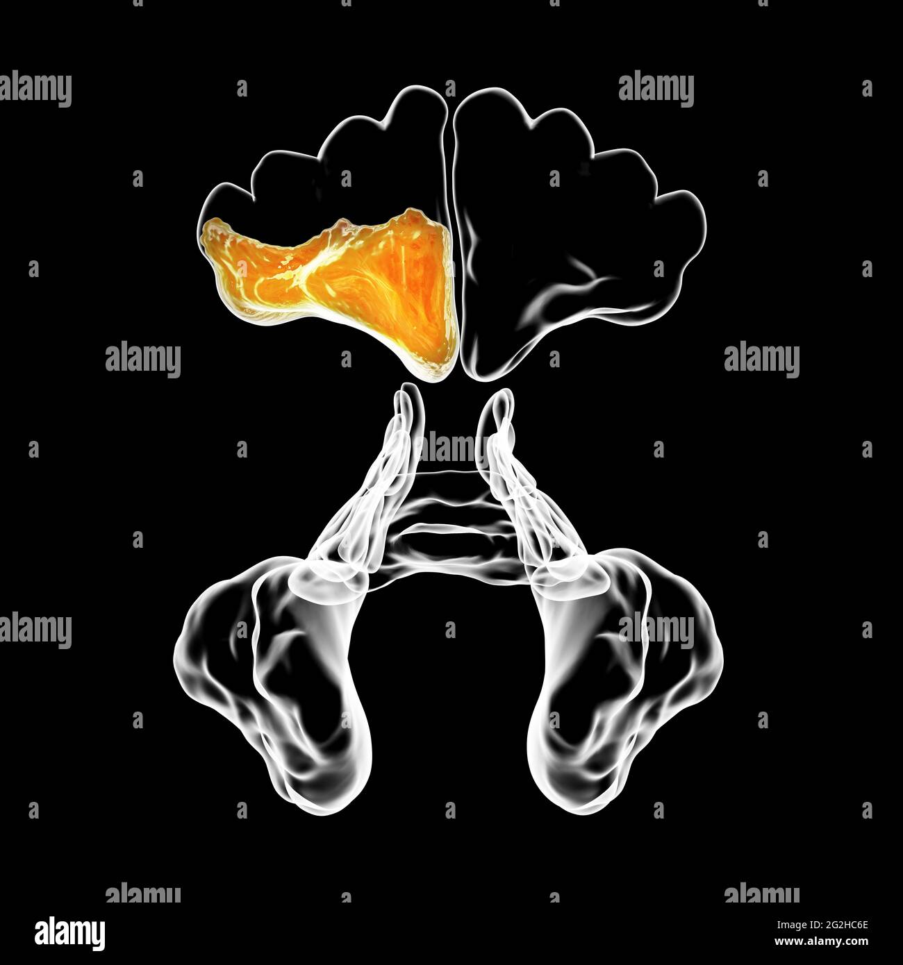 Sinusitis, Abbildung Stockfoto