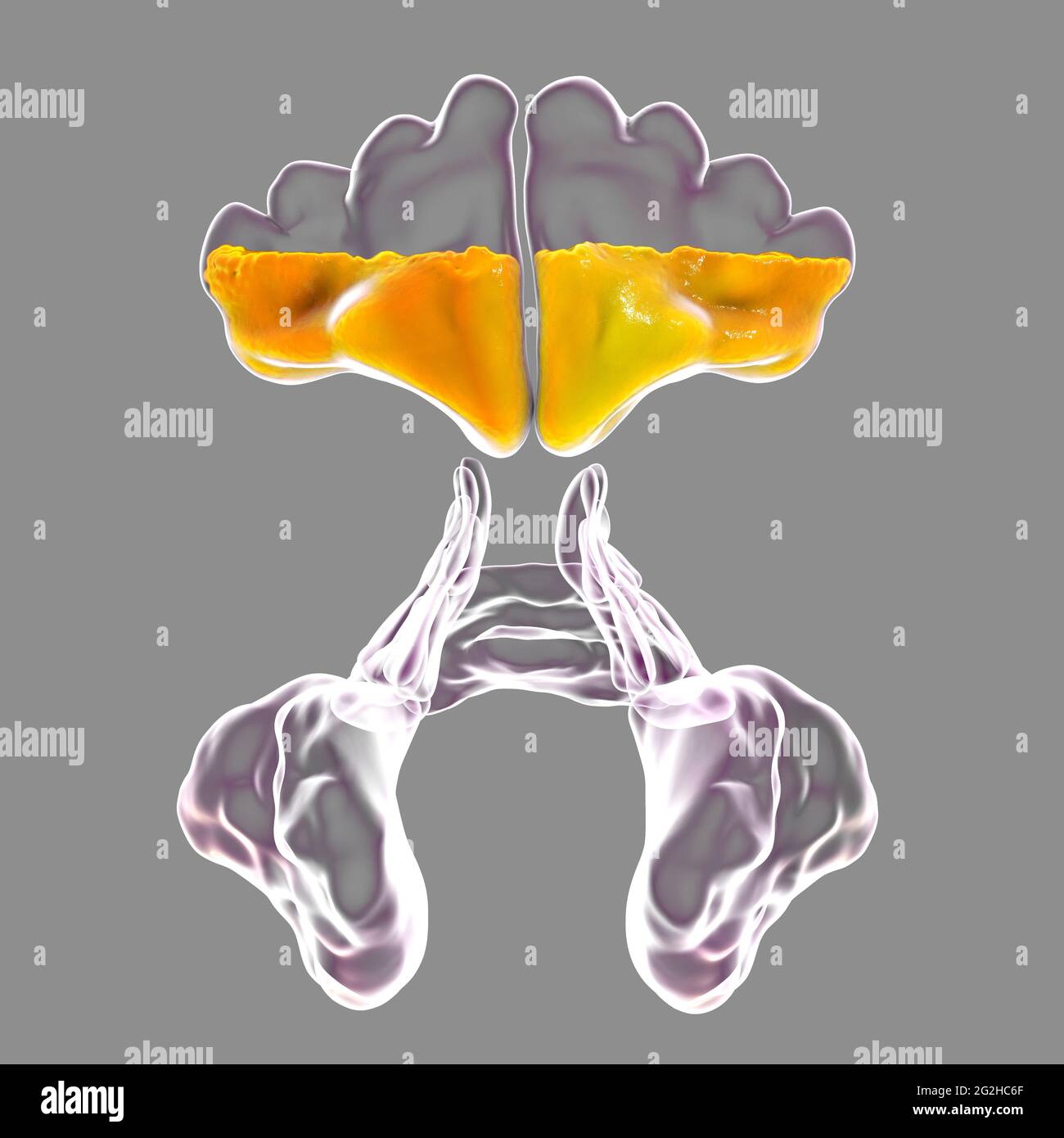 Sinusitis, Abbildung Stockfoto