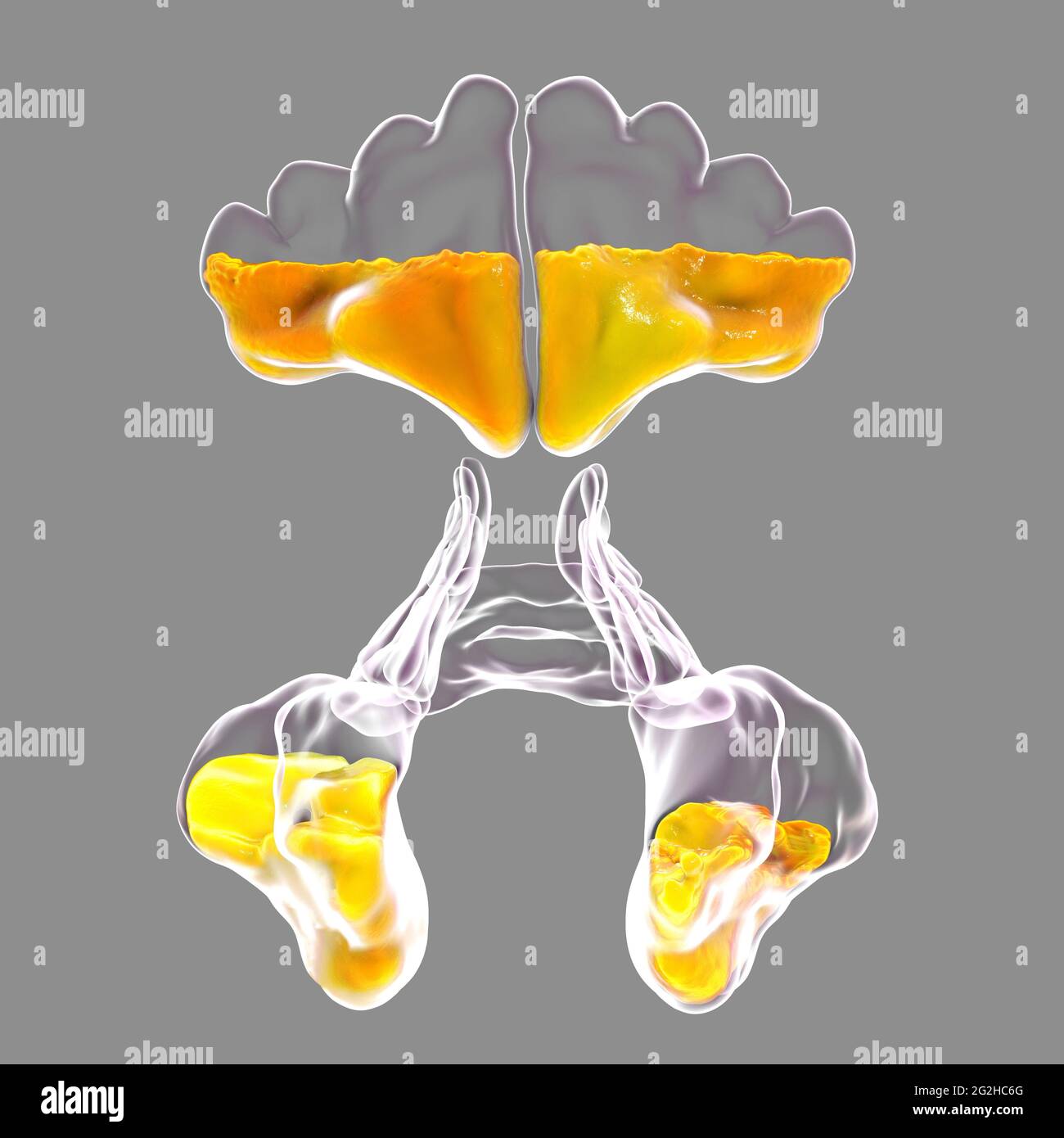Sinusitis, Abbildung Stockfoto